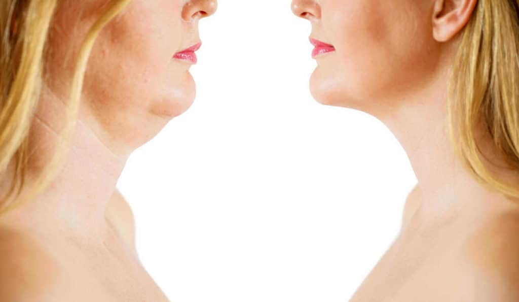 Double Chin treatment Solihull before and after results