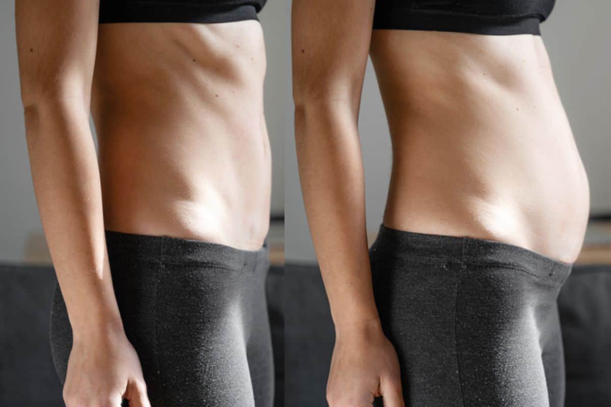 How long does diastasis recti take to improve Solihull?