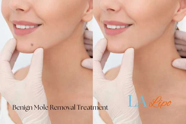 Before-and-after results following benign mole-removal treatment Solihull
