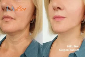 hi-fu for wrinkles Solihull before and after results