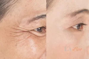 Before and after results of woman - HI-fu wrinkles reduction treatment Solihull
