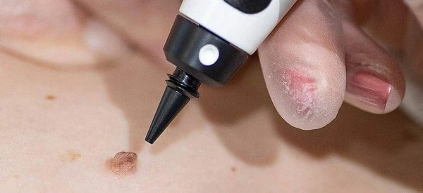 skin tag removal using cryopen Solihull