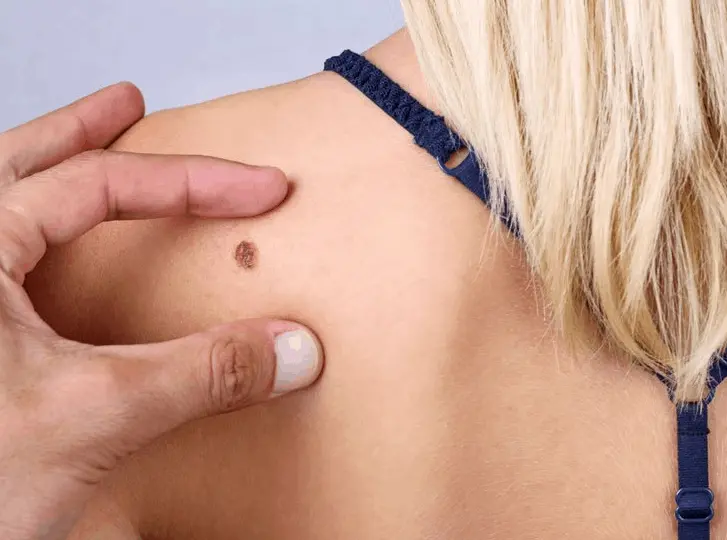 woman having mole removal Solihull consultation before treatment.