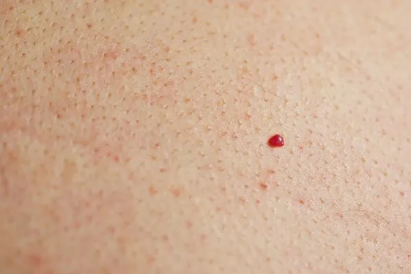 close up of a cherry angioma Solihull
