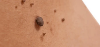 image of a skin tag Solihull