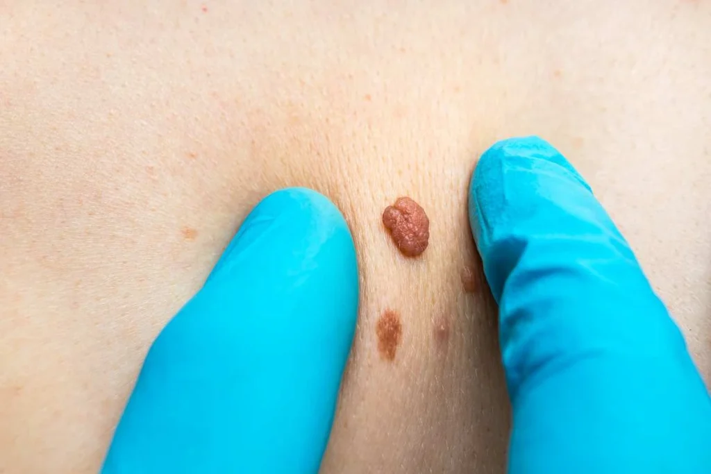 Consultant examining a skin tag Solihull