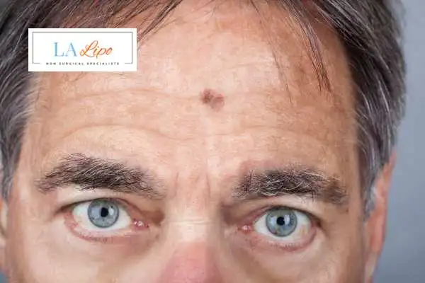 Solar Lentigo Removal Solihull image of man with mark on his forehead