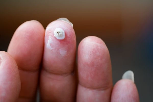 wart on person finger - cryotherapy to treat from LA LIPO Solihull