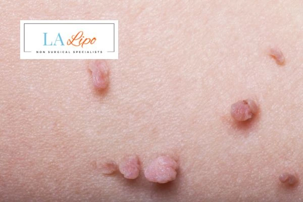 Does cryopen skin tag removal Solihull hurt? Find out now call our team today!