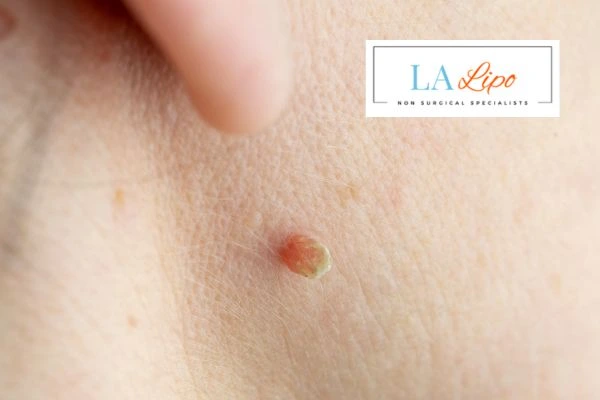 Book skin tag removal Solihull today speak to our team now!