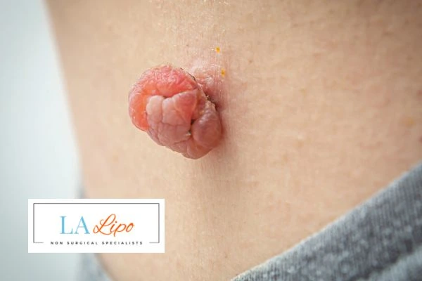 Interested in skin tag removal Solihull? Concerned about the pain? Find out more today!