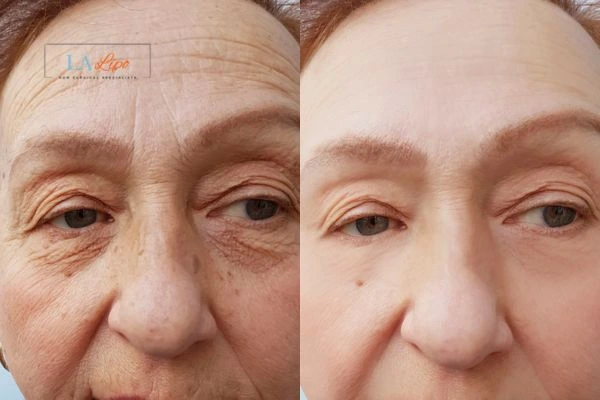 The powerful benefits of Morpheus8 Treatment Solihull - Call Our team today!