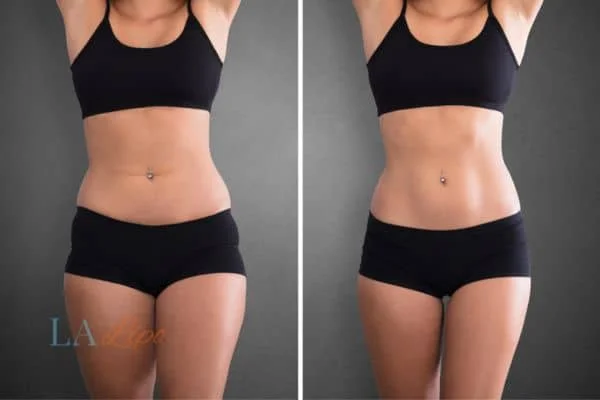 before and after results of non-surgical treatment to help a woman's body image and mental health Solihull