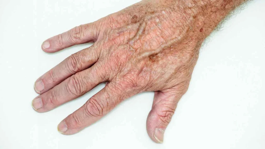 Male hand showing age spot Solihull