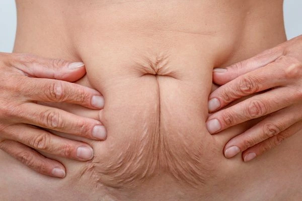 Should I Combine Diastasis Recti Treatment with Body Contouring for Better Results Solihull?