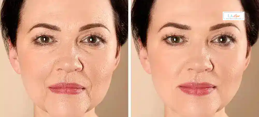 How Long Does It Take to See Results and How Long Do They Last Solihull?