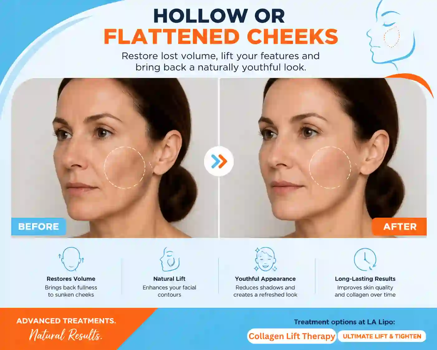 Sign #4: Hollow or Flattened Cheeks Solihull