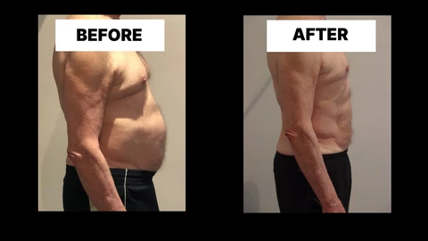 What Symptoms Can Diastasis Recti Cause in Men? Weak Core, Back Pain and Poor Posture Solihull